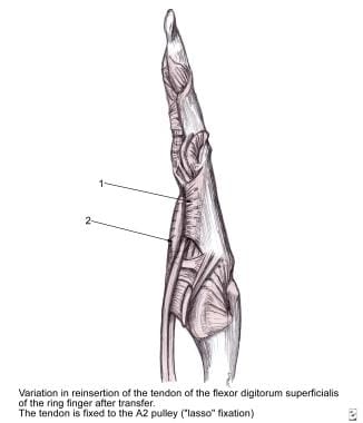 The Zancolli lasso procedure, in which the flexor 