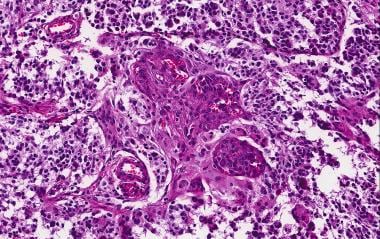 Pathology of Diffuse Astrocytomas. This glioblasto