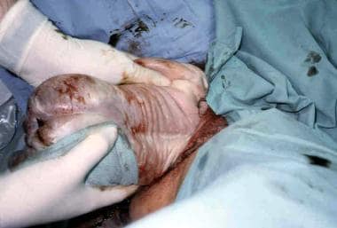 Assisted vaginal breech delivery. The anterior arm