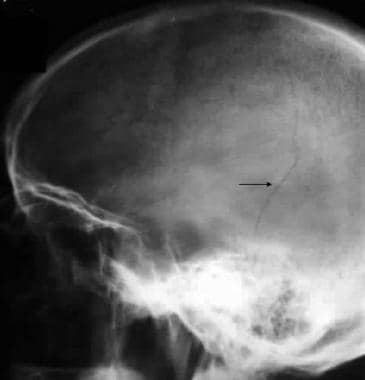 Skull radiograph in a man shows a linear temporopa
