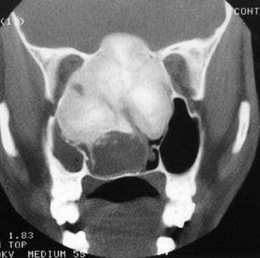 Coronal CT scan shows craniofacial fibrous dysplas