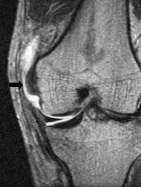 Grade III medial collateral ligament tear on a cor