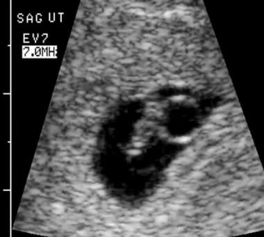 Embryonale ondergang. Vaginale scanning bepaalde de 