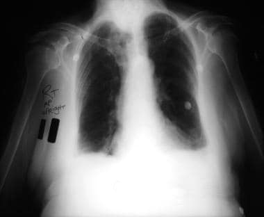 Emergent Management of Pleural Effusion. Anteropos