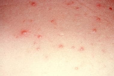 Steroid acne. Note pustules and absence of comedon