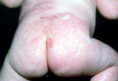 The reticulated mottling is observed on the skin o