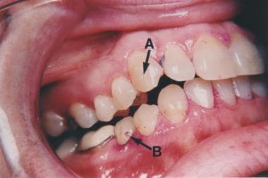 Enamel pitting in tuberous sclerosis. Pinpoint siz