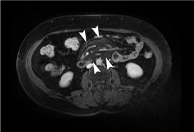 Axial contrast-enhanced MRI of central hyperintens