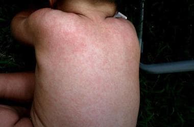 Roseola infantum. Image courtesy of Wikimedia Comm