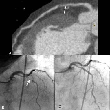 CT angiography and catheterization: Multiplanar re