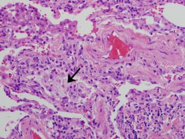 A case of hypersensitivity pneumonitis in a 48-yea