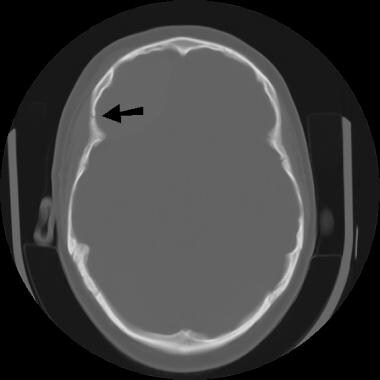 Image depicts a fracture of the right frontal bone