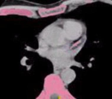 Coronary artery calcification - CT. Image obtained