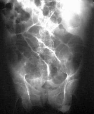 Plain abdominal radiograph of the abdomen in a 72-