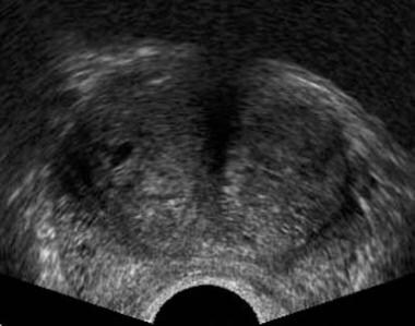 Axial transrectal ultrasonographic scan in a patie
