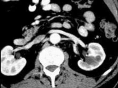 Case 22. Left renal cell carcinoma. Anterior compo