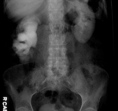 Delayed intravenous pyelogram (IVP) film with righ