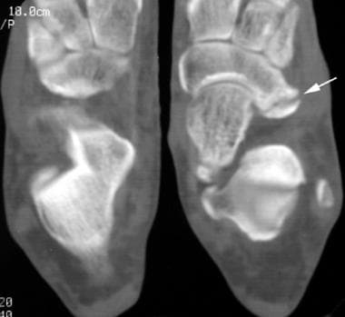CT scan in a patient with unilateral calcaneonavic
