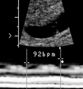 La vârsta gestațională de 5,5 săptămâni, ritmul cardiac embrionar