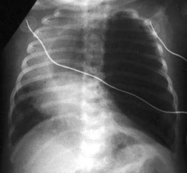 A frontal radiograph of the chest in a neonate sho