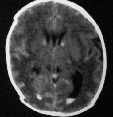 Axial nonenhanced computed tomography scan. The im