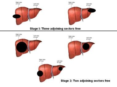 Sectors of the liver with tumor location based on 