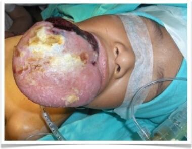 Preoperative image of aforementioned patient with