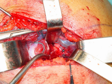 Completion of the procedure demonstrates significa