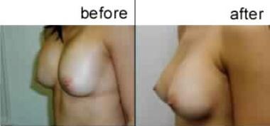 Breast augmentation, subglandular. This patient ha