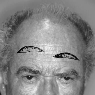Several different incisions for mid forehead lifts