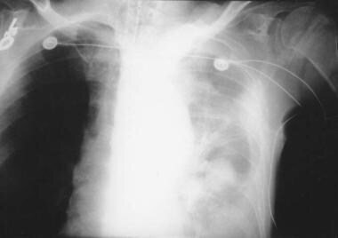 Chest radiograph of a patient with aortic dissecti