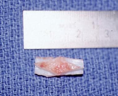 Anterior rib graft with a diamond shape. Note it m