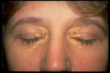 Xanthelesma of four eyelids in patient with hyperl