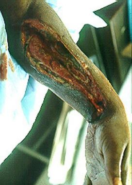 Left upper extremity shows necrotizing fascitis in