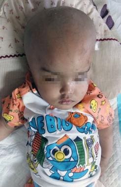 A 1-year-old boy with macrocephaly. The image illu