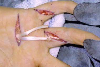 In the same patient, the ring and small fingers' f