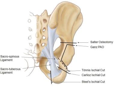What is a periacetabular osteotomy?