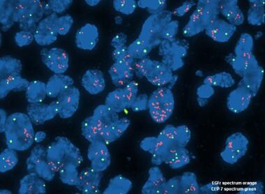 Pathology of Diffuse Astrocytomas. Fluorescent in