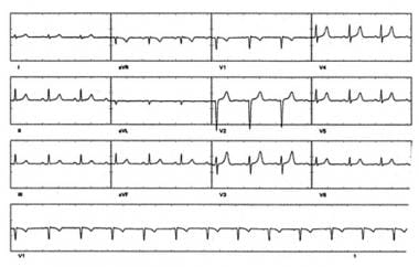 Catheter Ablation. Sinus rhythm in the same patien