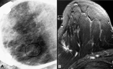 A, Image in a patient with a focal irregular nodul