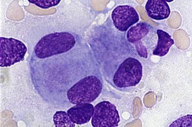 Pediatric myelodysplastic syndromes pathology. Mic
