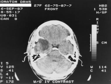Grade II astrocytoma in a 27-year-old woman. Nonen