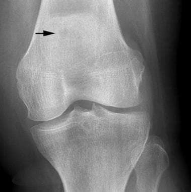 Anteroposterior radiograph of the knee demonstrate