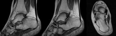 MRI in a patient with calcaneonavicular coalition.