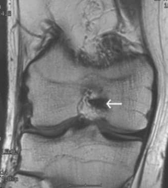 Chronic tear of the ACL with empty notch sign. T1-