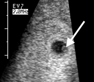Embryonale ondergang. Een normaal ogende dooierzak (arr