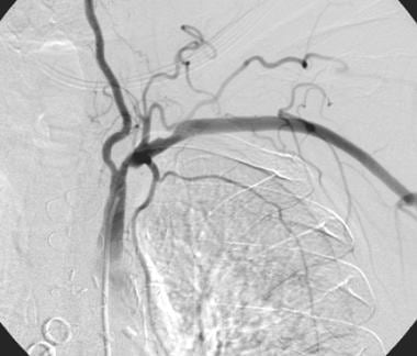 Patient presented with cardiac ischemia after a le