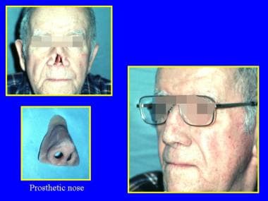 An artificial nose is attached with medical-grade 