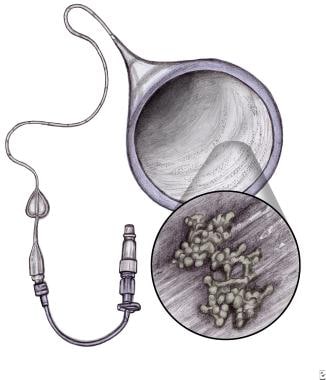 Fungal Infections in Preterm Infants. Percutaneous