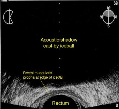 Transrectal sonogram illustrating the ice ball now